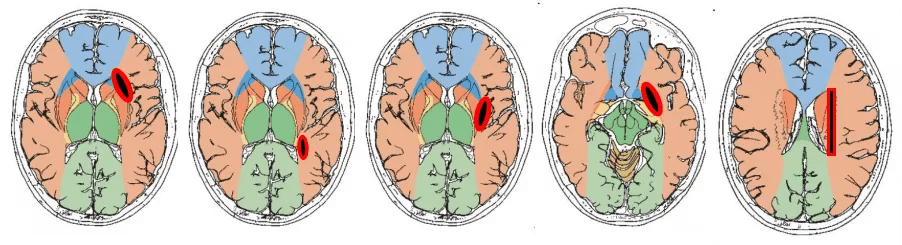 入門必讀 | 影像報告中少提的分水嶺腦梗死,解剖與分型