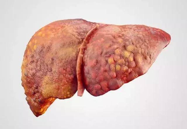 38岁男子,查出肝硬化,医生提醒:出现一种"红痣",尽早就医!