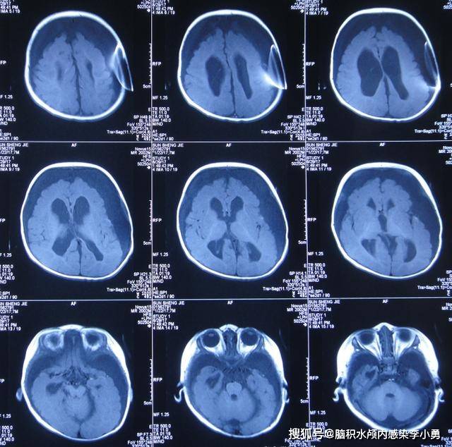 婴儿脑积水鞍上蛛网膜囊肿,软性内镜术后脑积水更重,现在孩子发育迟缓