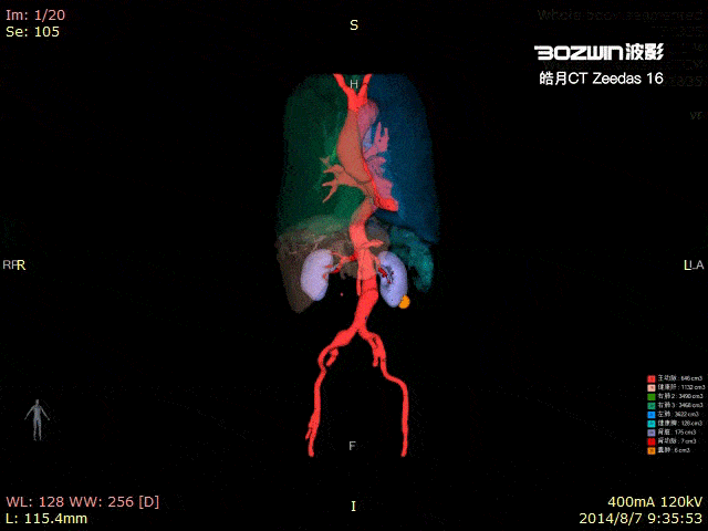 血管,肺,肝脏,肾脏,病灶等组织生动的三维容积渲染重建,同时借助