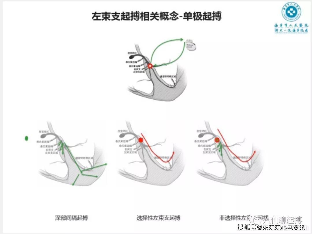 吉亚军老师左束支起搏心电图分析