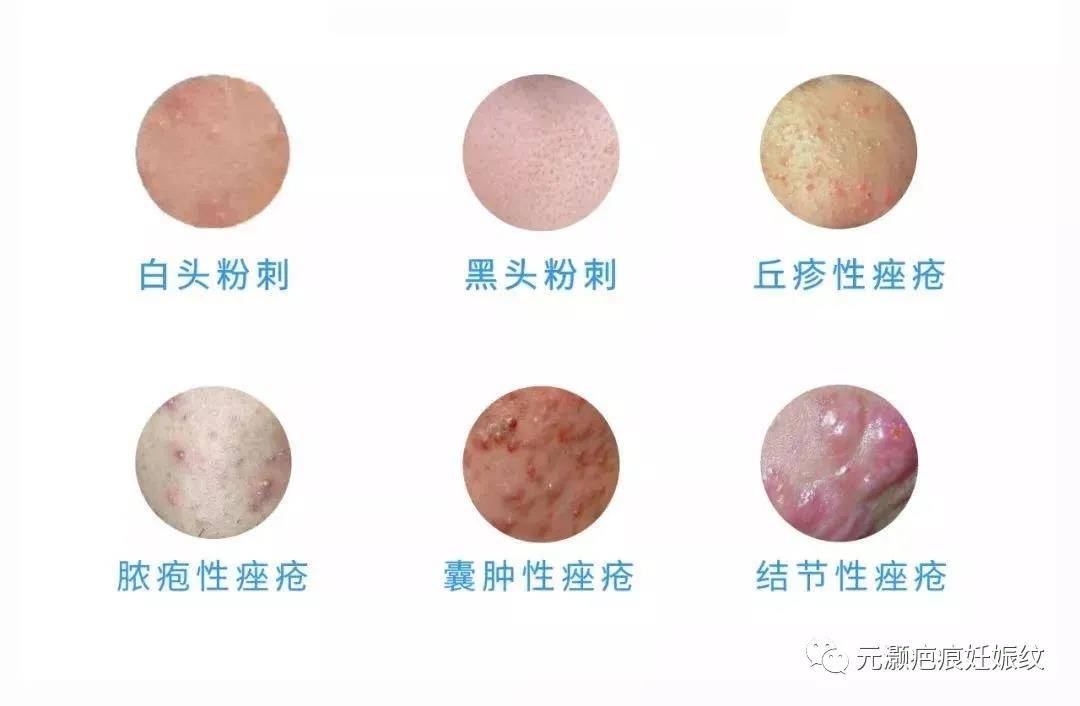 痘痘种类都分不清难怪祛痘总失败