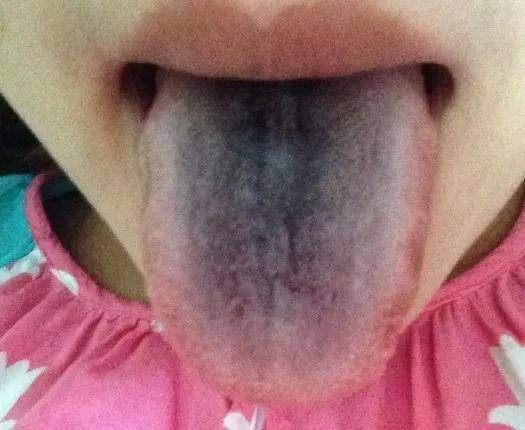 舌苔发黄发黑图片