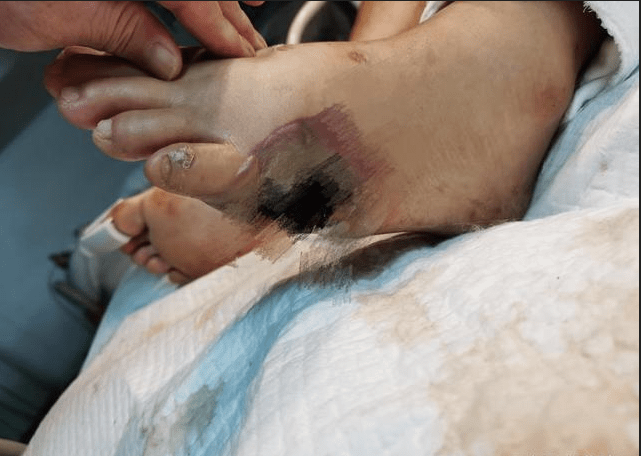 电严重击伤6月16日上午,王某文于砍伐树木的过程中不幸发生了触电事故