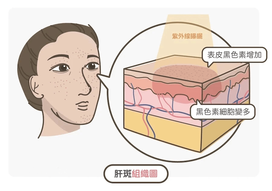 黃褐斑形成的原因不同,同時黑色素累及表皮和真皮的形態不同,治療