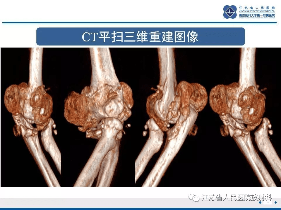 肘夏科氏关节病