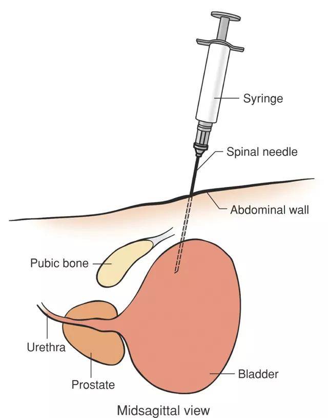 膀胱造瘘手术演示图图片