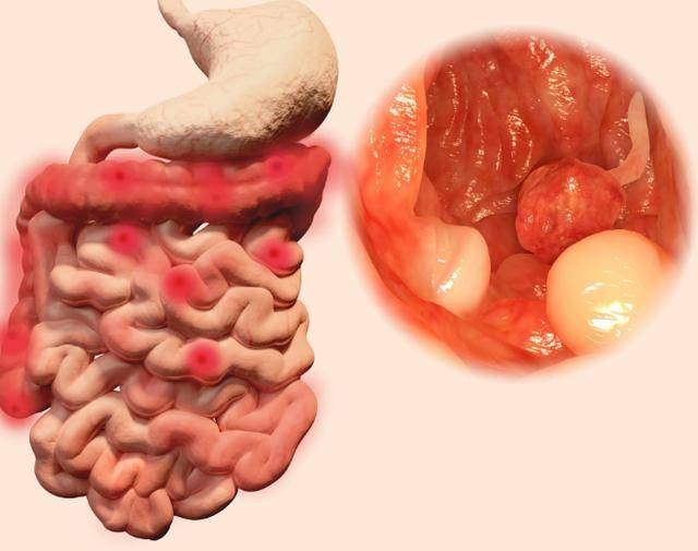 4,肠道腺瘤性息肉:肠道腺瘤性息肉是大肠息肉中相对危险的种类,可单发