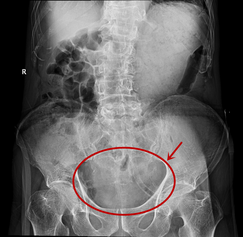 膀胱结石x线图片