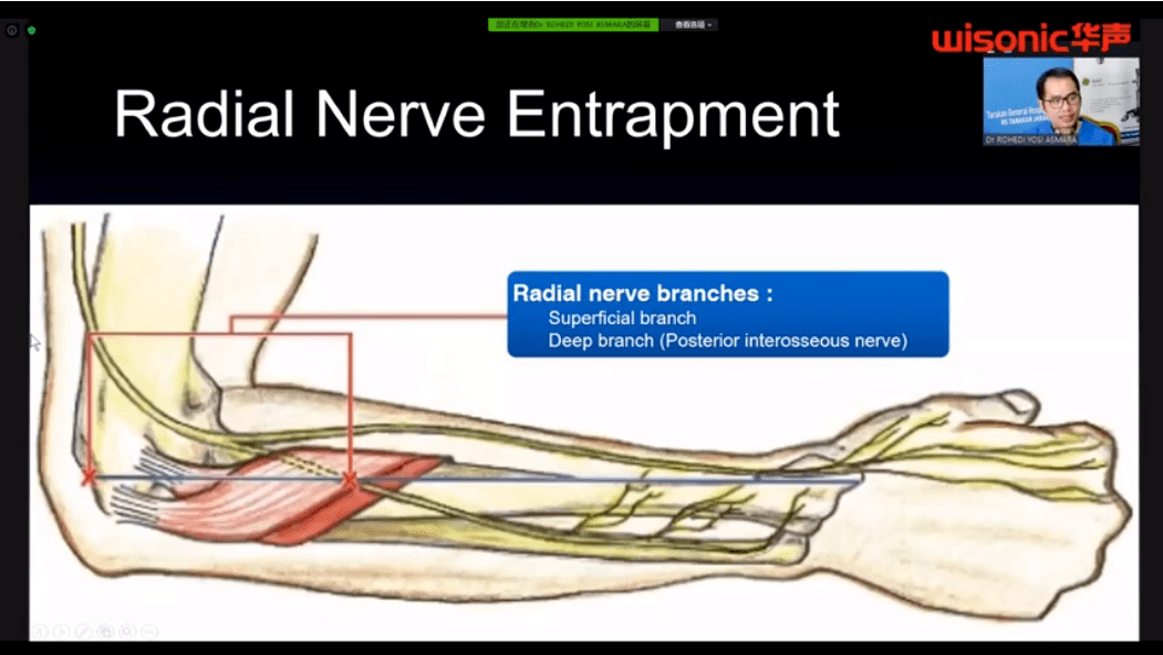 yosi的課程中理論與實踐相結合,圖中為橈神經解剖結構.