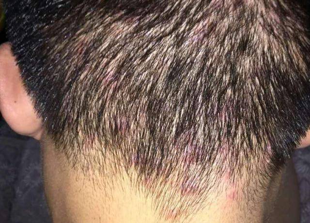 还能抠下沙子状的颗粒,出现这种症状主要是由于头螨刺激油脂分泌,而在