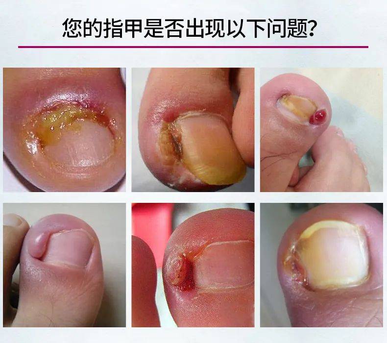 你的这些生活习惯,可能会导致甲沟炎