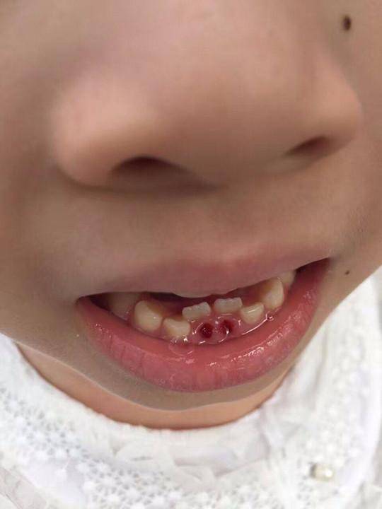 婴儿出牙牙龈溃烂图片图片