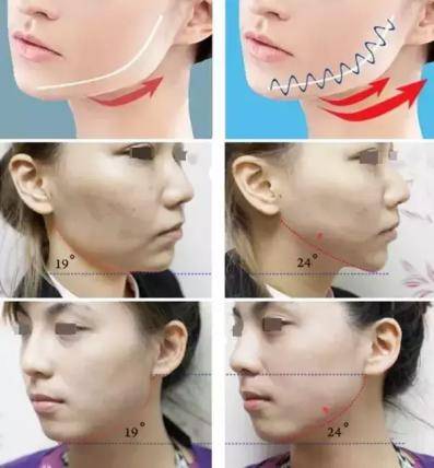 少女线提升图片,能让姐姐们乘风破浪的少女线是什么?_皮肤