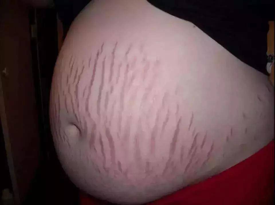 妊娠纹吓人图片图片