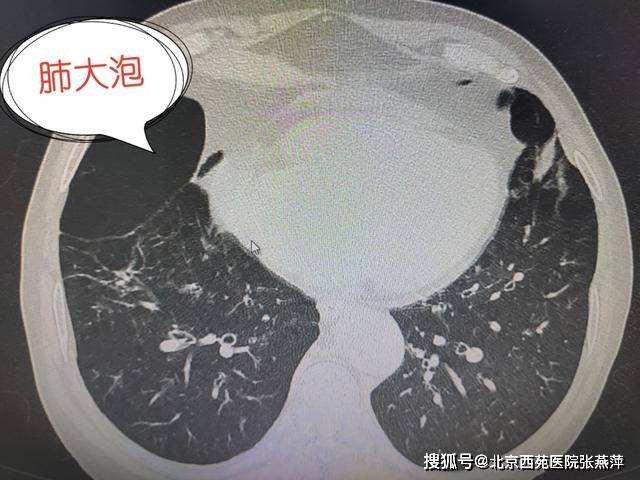 肺大泡是什么病图片