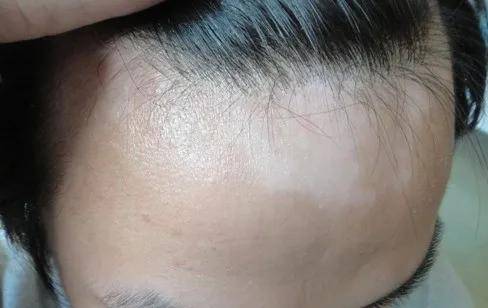 色素脱失程度不同,可表现为浅白色,乳白色,云白色和瓷白色,早期白斑多