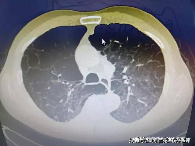 抽了一年电子烟的肺部图片