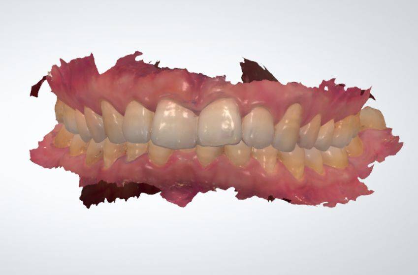 效果|襄阳3D全新数字化口扫，颠覆传统取模方式，欢迎前来体验！