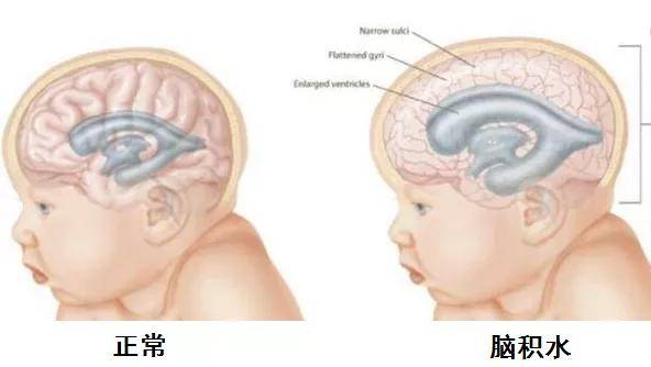 婴儿脑积水有哪些症状图片