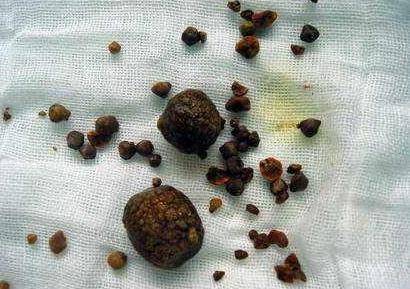 医学科普胆囊结石的初级预防小方法