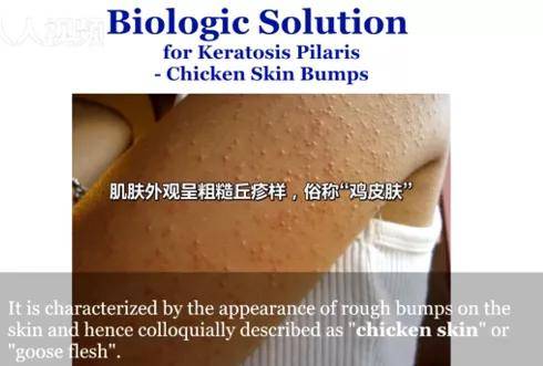 原创全民科普丨你最不想知道的真相来了,被嫌弃的鸡皮肤的一生