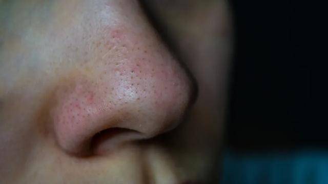 去黑头,别踩这 3 个坑才能成功,4周超过90%的人_皮肤