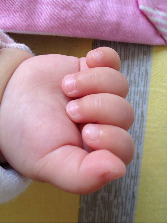 孩子手上长肉刺,吃维生素都不好,严重会影响孩子的身高