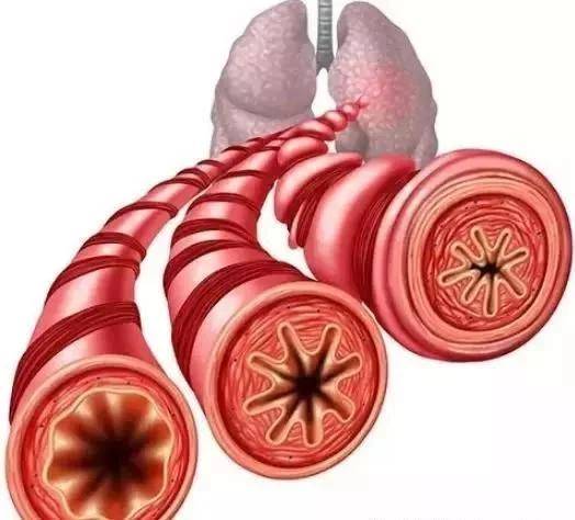 慢阻肺患者如何正确排痰非常重要推荐收藏