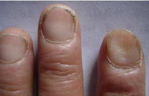 原创缺铁性贫血时手指甲可能会有这3个信号可别大意了