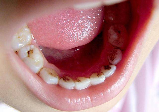 主要是这四个原因所致,越早知道越好大部分成年人的牙齿容易变黑的
