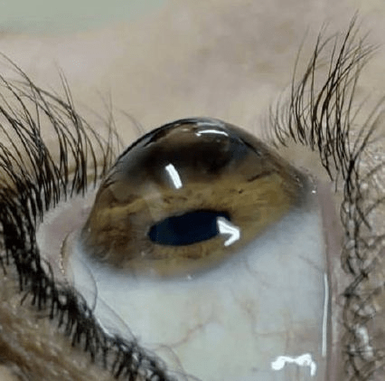 有一种眼病——圆锥角膜在早期发病时,症状与普通的近视,散光患者一样