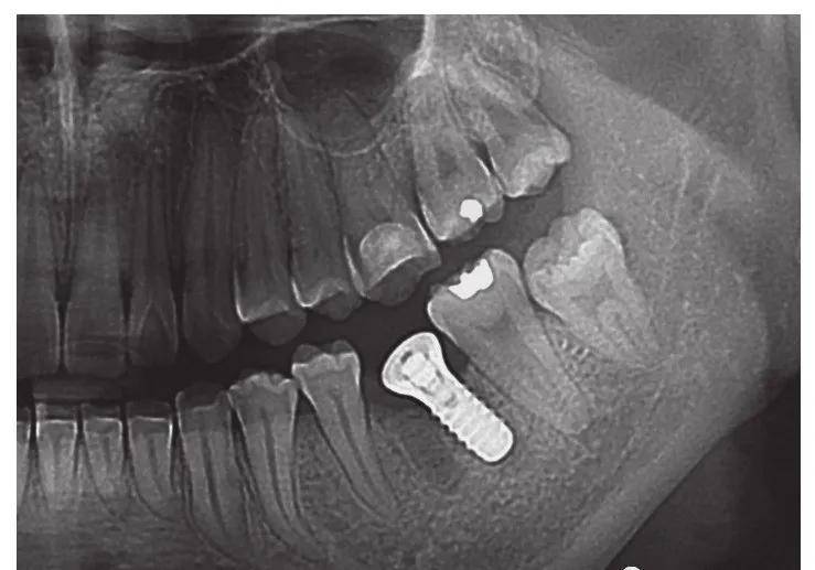 圖8-2術後全景片 見植體偏向遠中 3.