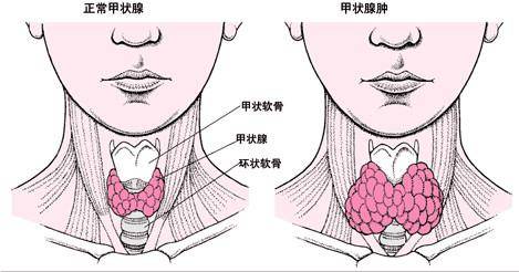 甲狀腺腫和甲狀腺結節的區別是什麼?從四個方面告訴你