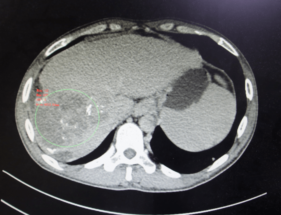原发性肝癌晚期并多发性转移,生命该如何延续?