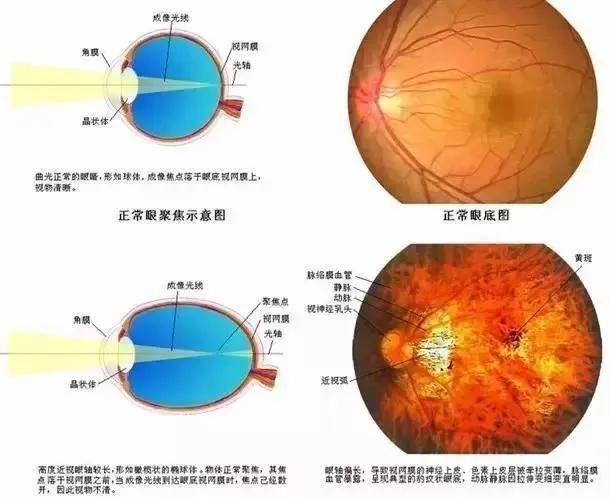 你的白内障竟然是由近视引起的?高度近视的危害不可小觑!