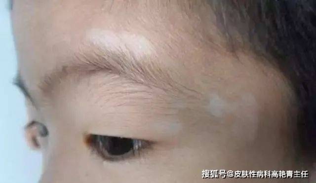 3,贫血痣:本病于生后或儿童期发病,位置和形态相对不变,终生不退; 4