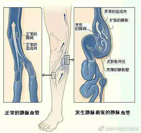 下肢静脉瓣膜位置图片图片