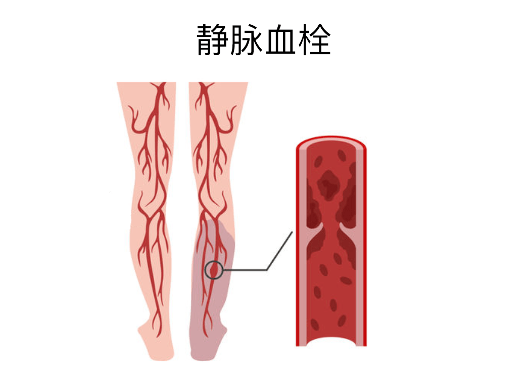 静脉血栓这种堵住动脉血管的血块就是动脉血栓.