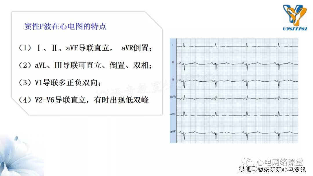 p波双向心电图意义图图片