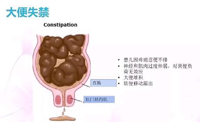 儿科医生给出了最全的治疗方案_粪便