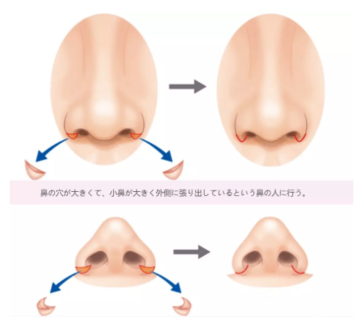 双眼皮|顾客要整成明星？参考这个照着做就行了