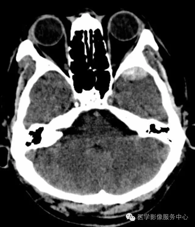 頭顱ct的觀察盲區,你都知道嗎?