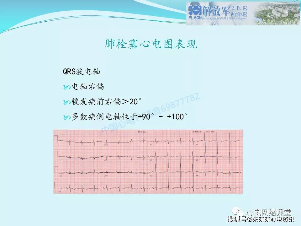 典型s1q3t3心电图表现图片