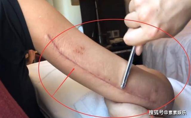 万茜手臂还没完全康复,还需6个月的时间等待恢复,防止肌肉萎缩