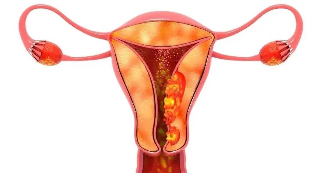 nk细胞免疫疗法,让"乳腺癌","宫颈癌"细胞无处可逃