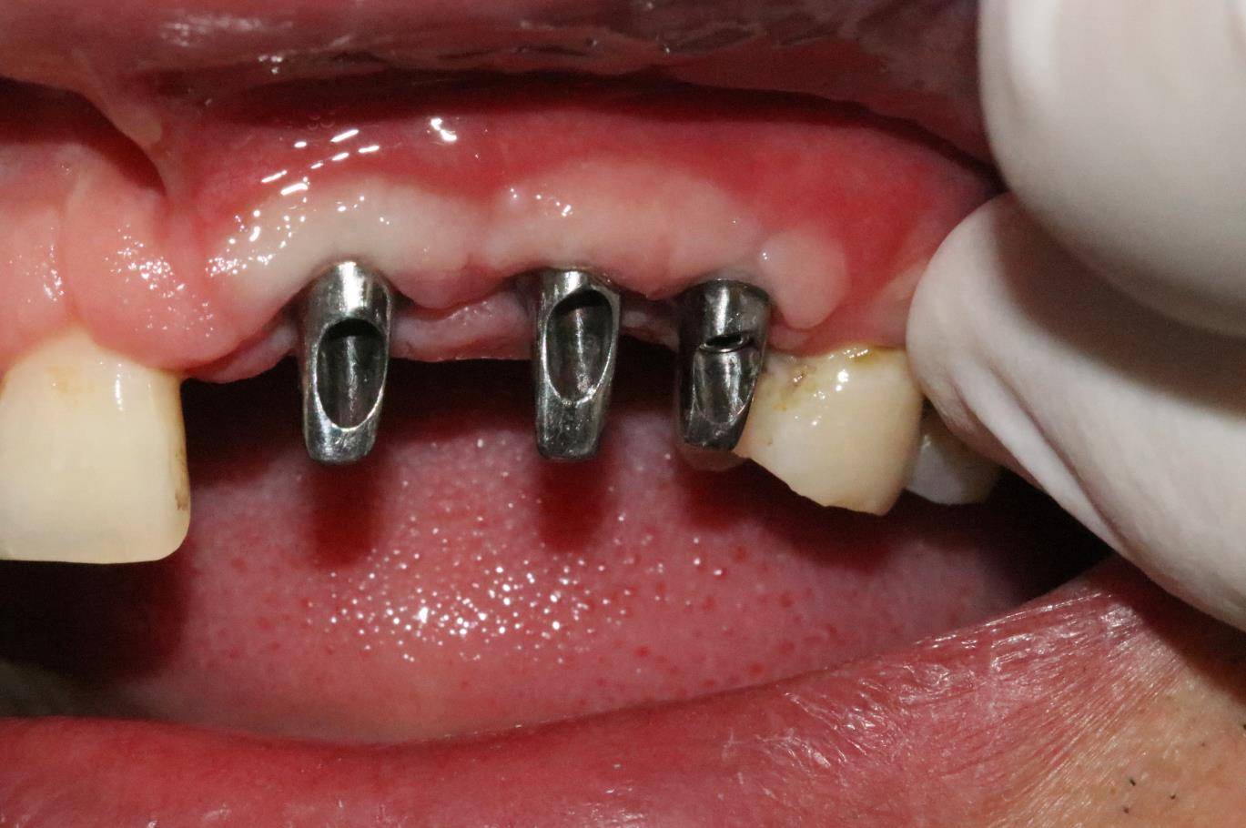 种植牙治疗案例部分图集——贝洁口腔微分享