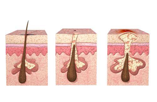 鸡皮肤质别怕,还有救!_手机搜狐网