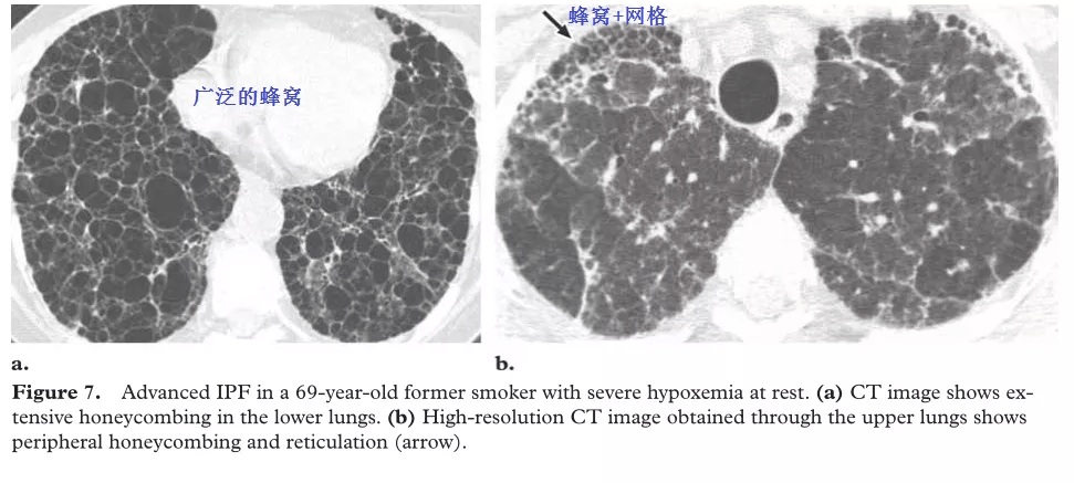 什么是特发性肺间质纤维化 e586e8d930cf4b42a6c5e12a738beb7f.png