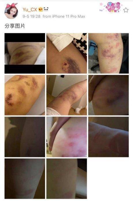 本性难移死亡宣告再次家暴女友女友遍体鳞伤不忍直视